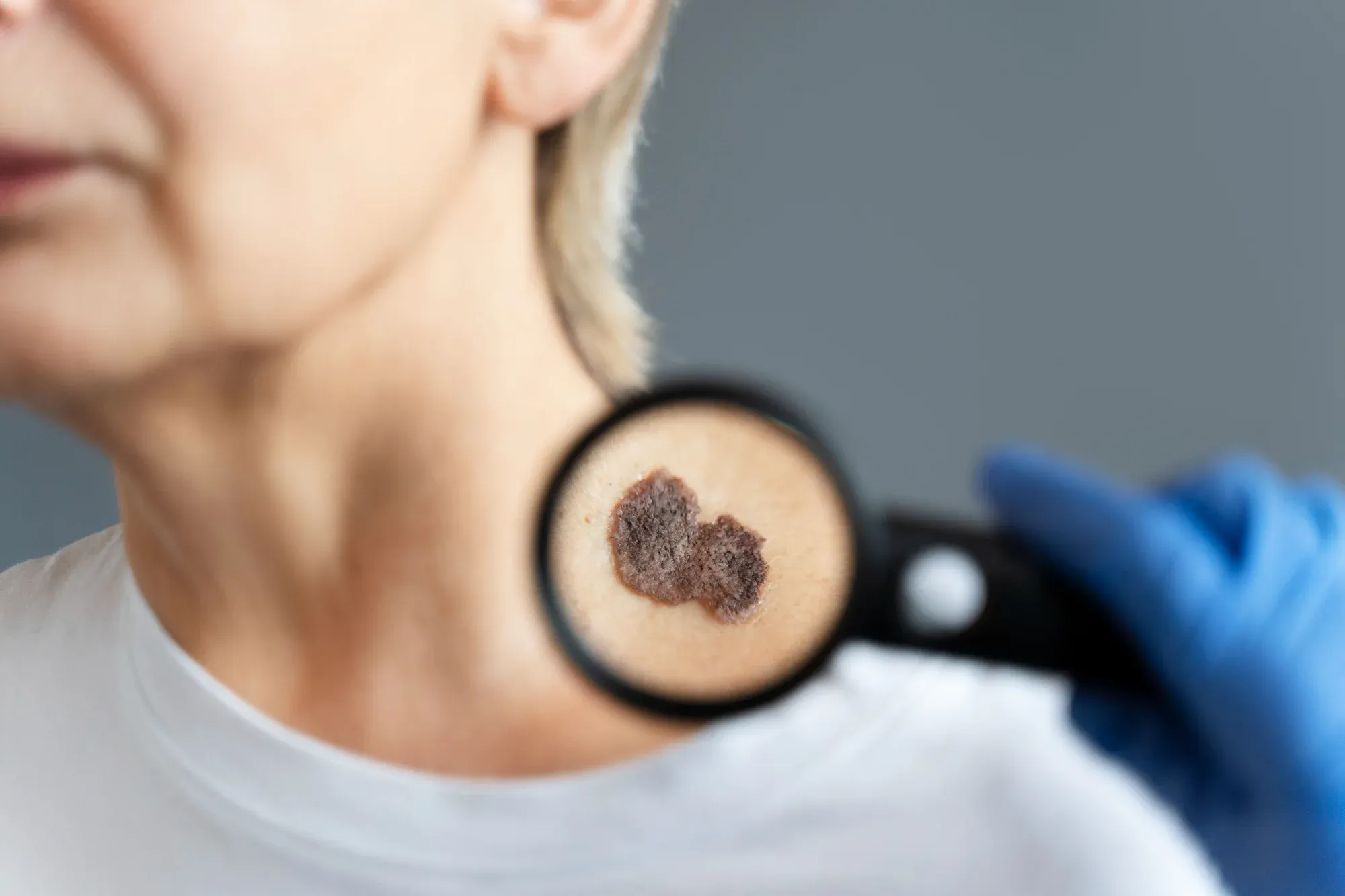 Suspicious melanoma lesion on skin under magnifying glass, highlighting early signs and symptoms of skin cancer.