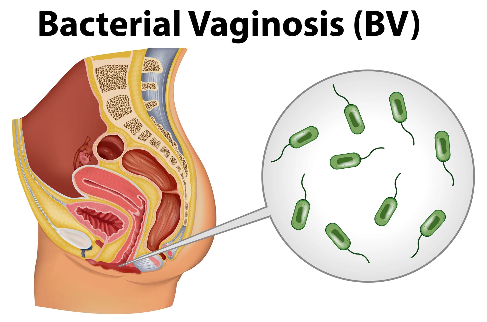 medical illustration of the female reproductive system highlighting vaginal area with magnified view of bacteria, representing bacterial vaginosis (BV) infection often linked to myths about Blue Waffle.