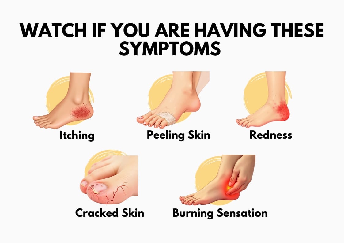 Infographic showing symptoms related to Sweaty Feet, including itching, peeling skin, redness, cracked skin, and burning sensation on the feet.