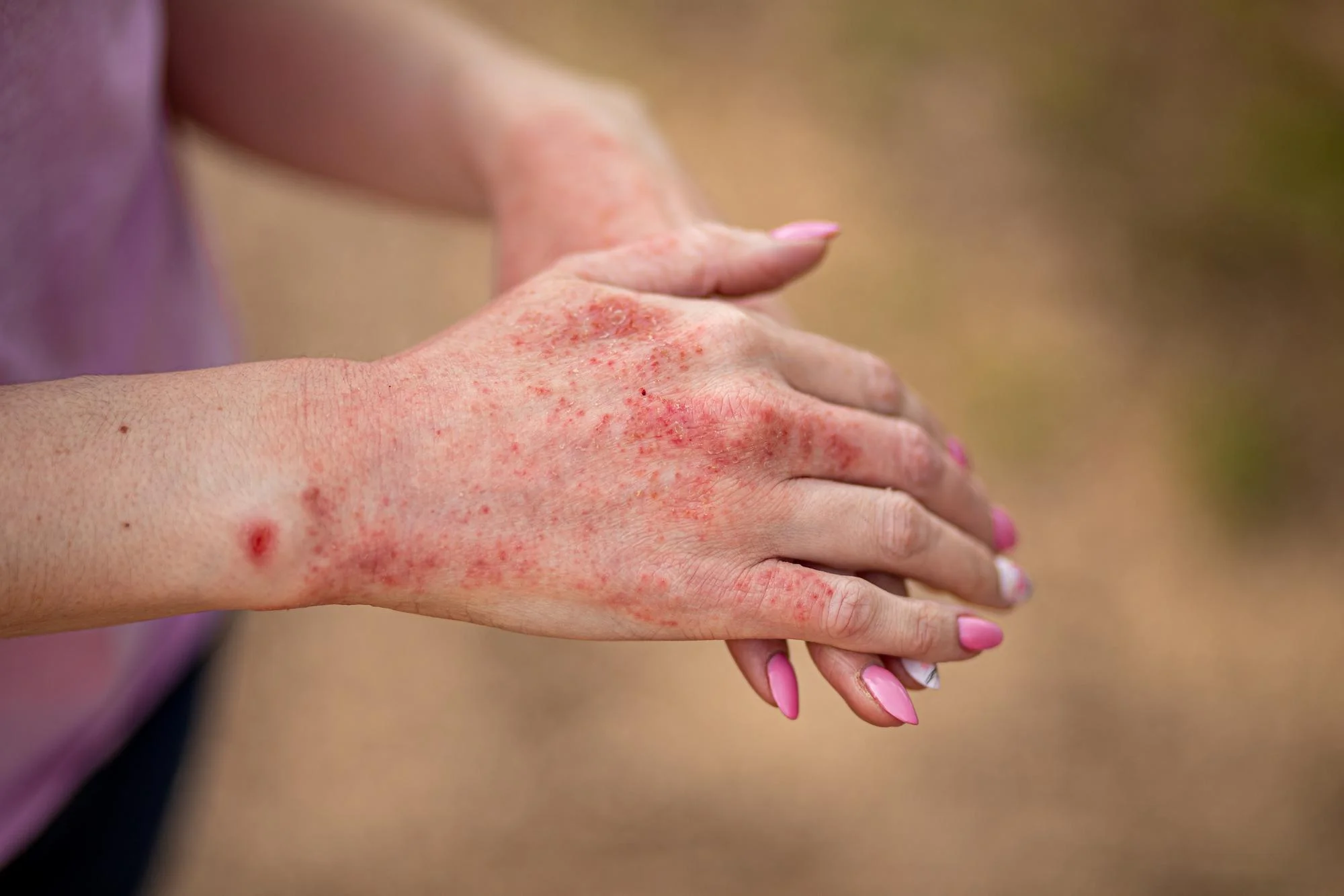 A close-up of a hand showing red, irritated patches of eczema and psoriasis, illustrating how Batana Oil for Eczema and Psoriasis may help soothe inflammation, reduce dryness, and support skin healing.