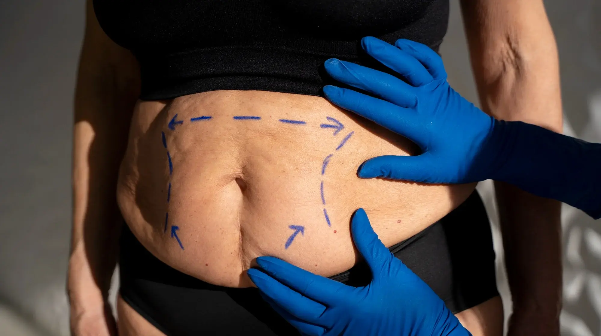 This image shows a liposculpture liposuction procedure in which a surgeon marks the abdominal area to guide precise fat removal and body contouring.