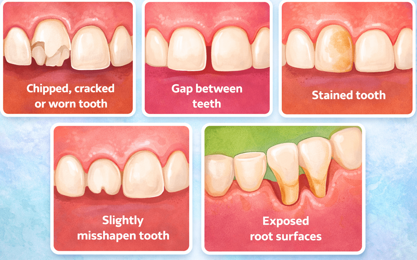 Illustration showing common dental issues treated with cosmetic dental bonding including chipped tooth, gap between teeth, stained tooth, misshapen tooth, and exposed root surfaces