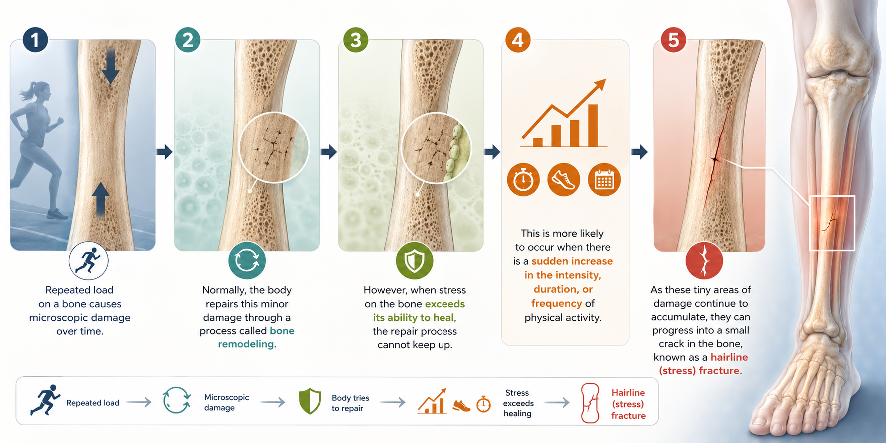 Infographic illustrating the step-by-step development of a hairline fracture.