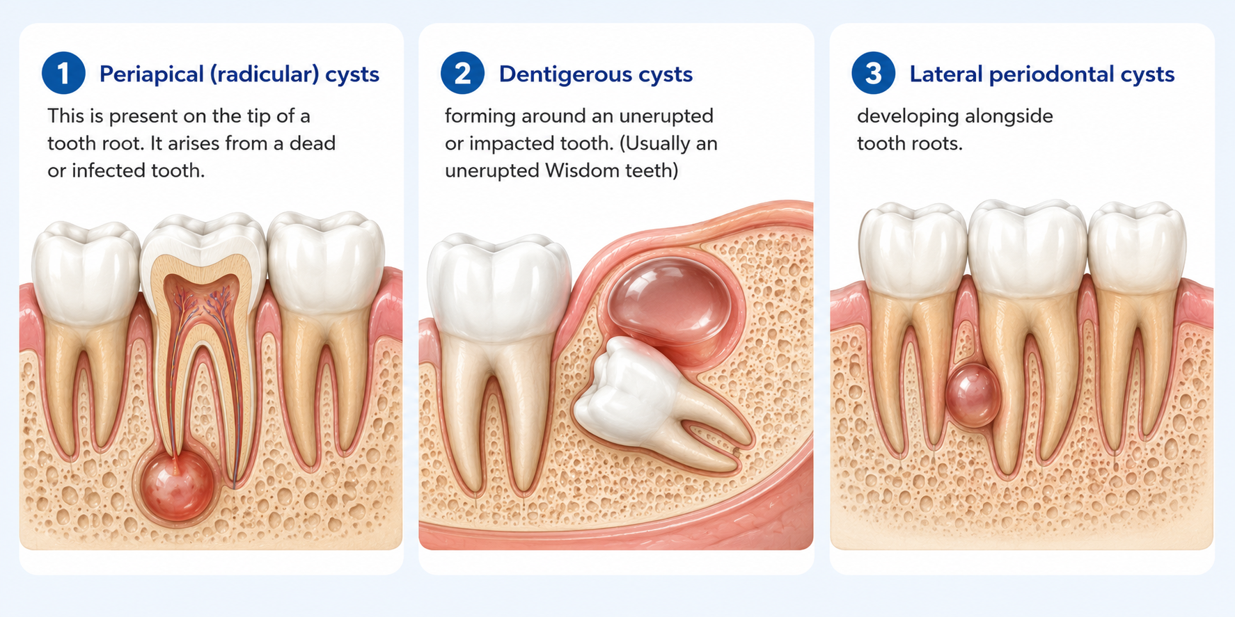 Educational infographic illustrating the common types of dental cysts