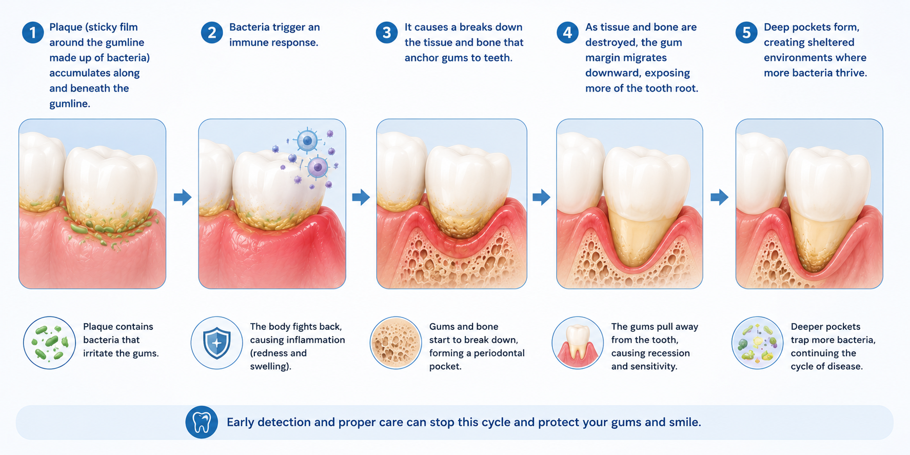 Gum Disease vs Gum Recession infographic showing the progression from plaque buildup and bacterial infection to inflammation