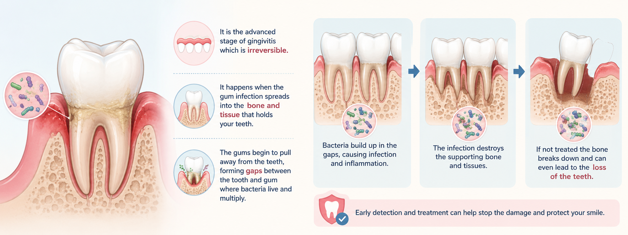 Medical illustration of periodontitis showing advanced gum disease with gum recession, deep periodontal pockets, bacterial infection, bone loss, tissue destruction, and potential tooth loss.