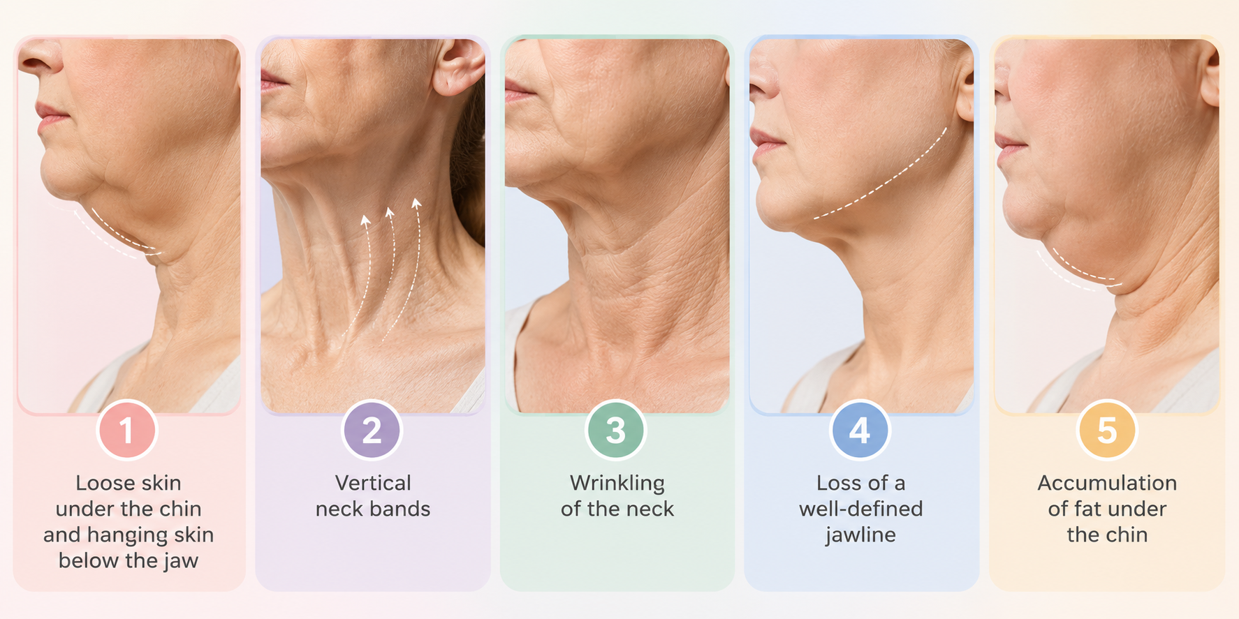 Turkey Neck characterized by loose skin under the chin, vertical neck bands, neck wrinkling, loss of a well-defined jawline, and fat accumulation under the chin.