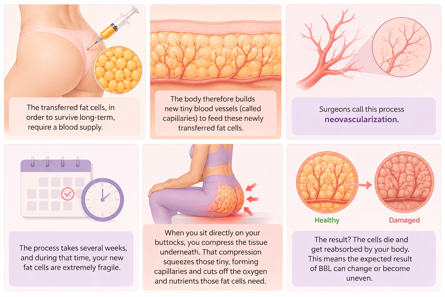 Medical illustration explaining why you can't sit after a BBL, showing fat cell survival, new blood vessel formation, tissue compression, and the impact on recovery results.