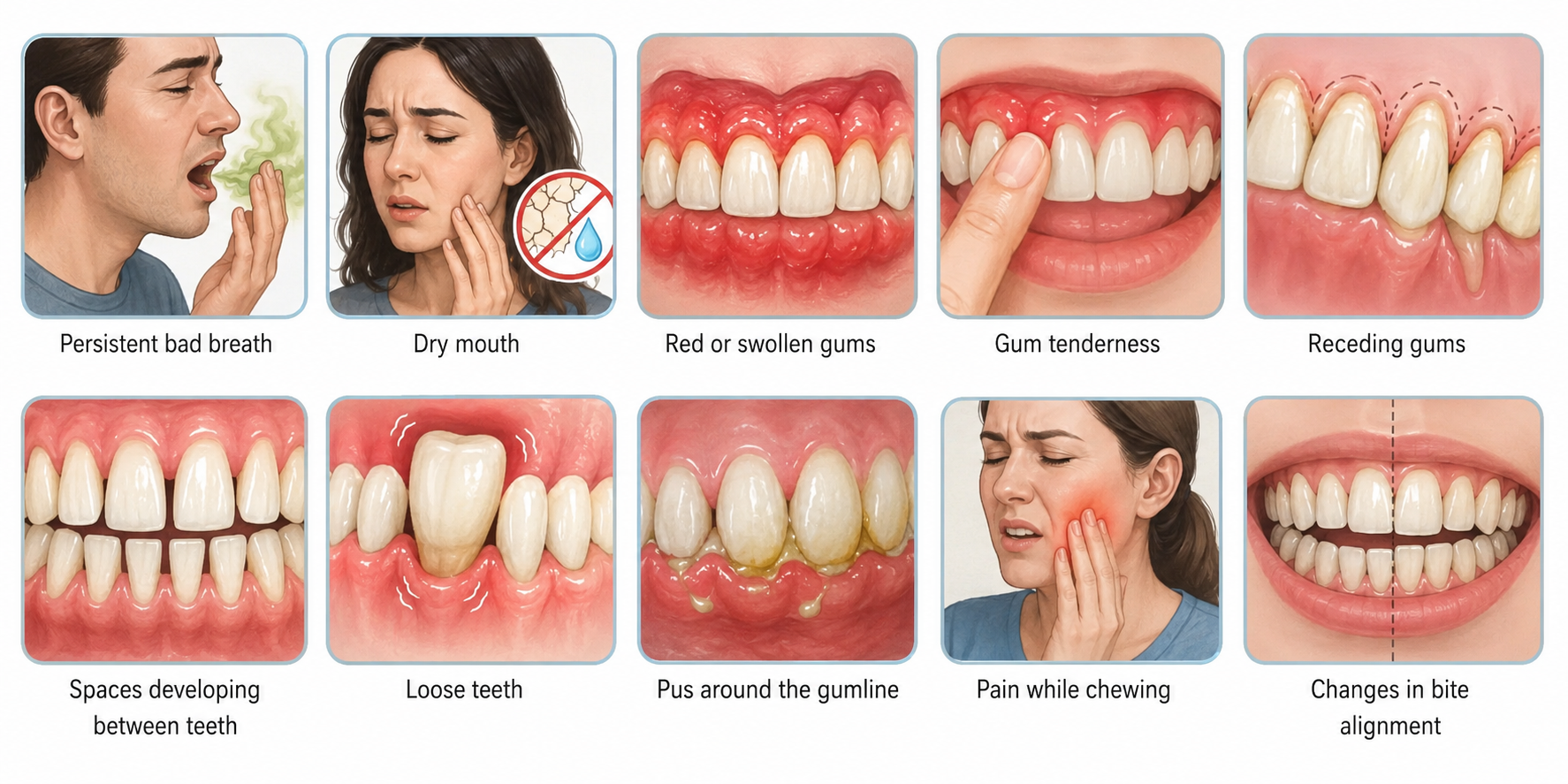 Medical illustration showing the early symptoms of gum disease in smokers and vapers, including persistent bad breath, dry mouth, red or swollen gums, gum tenderness, receding gums, spaces developing between teeth, loose teeth, pus around the gumline, pain while chewing, and changes in bite alignment.
