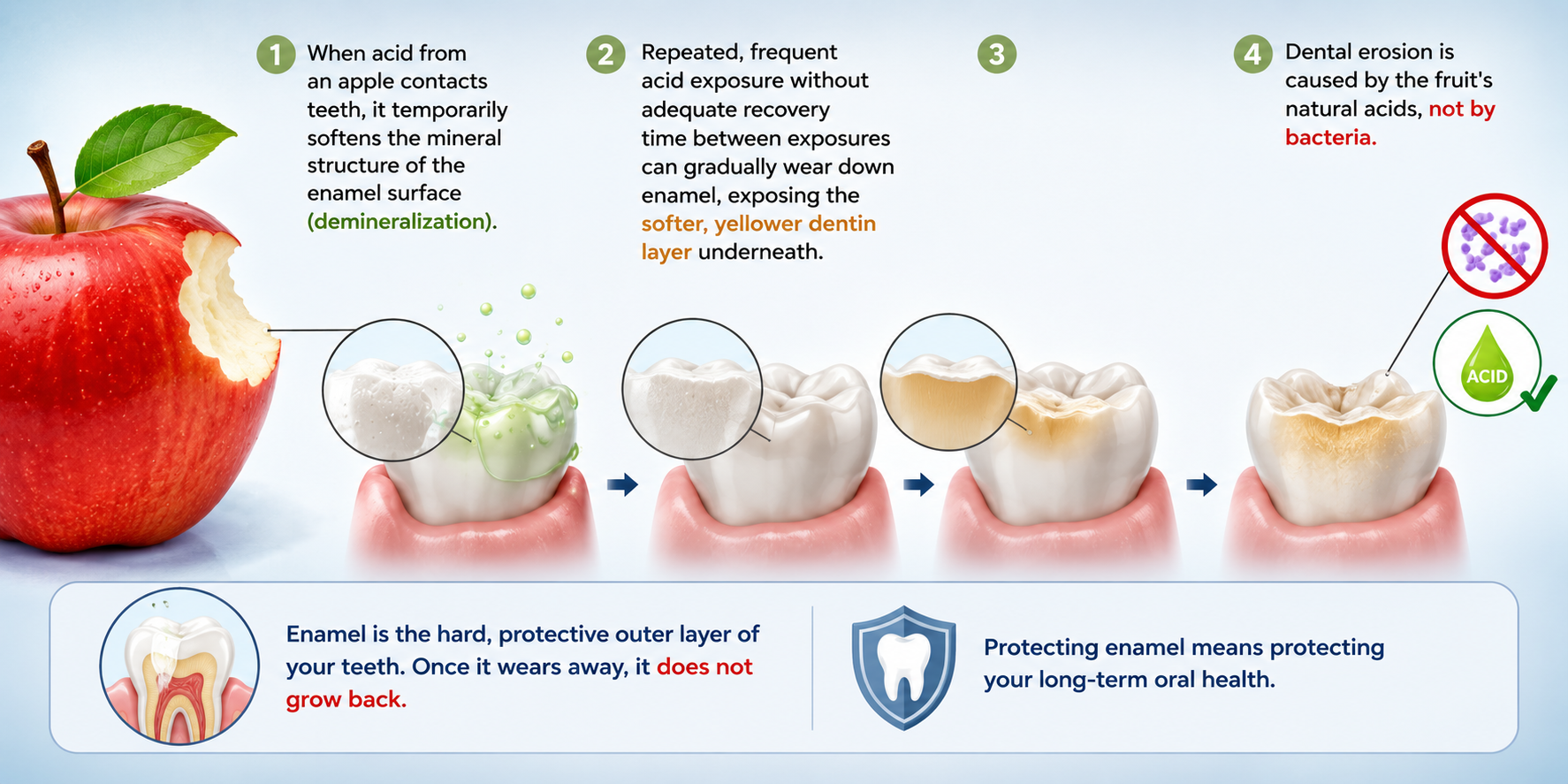 Medical illustration showing the stages of dental erosion (chemical wear caused by acid), from enamel demineralization to enamel loss and dentin exposure due to repeated acid exposure.
