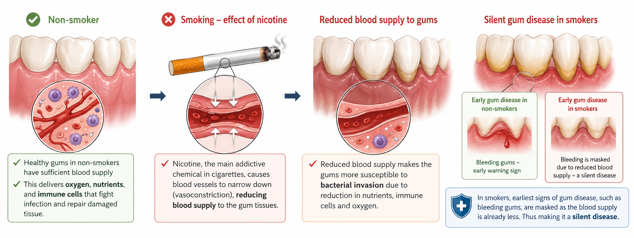 Medical illustration showing how smoking reduces blood flow to the gums. It compares healthy gums with smoker's gums, explains nicotine-induced narrowing of blood vessels, reduced oxygen, nutrients, and immune cells, increased bacterial invasion, and how early gum disease can remain hidden due to masked bleeding.