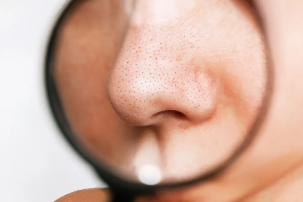 nose with visible blackheads and enlarged pores