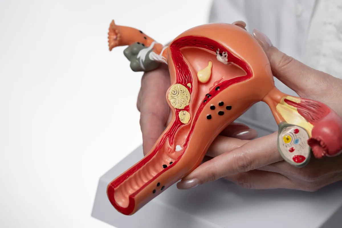 medical anatomical model of the uterus and ovary displaying ovarian cysts
