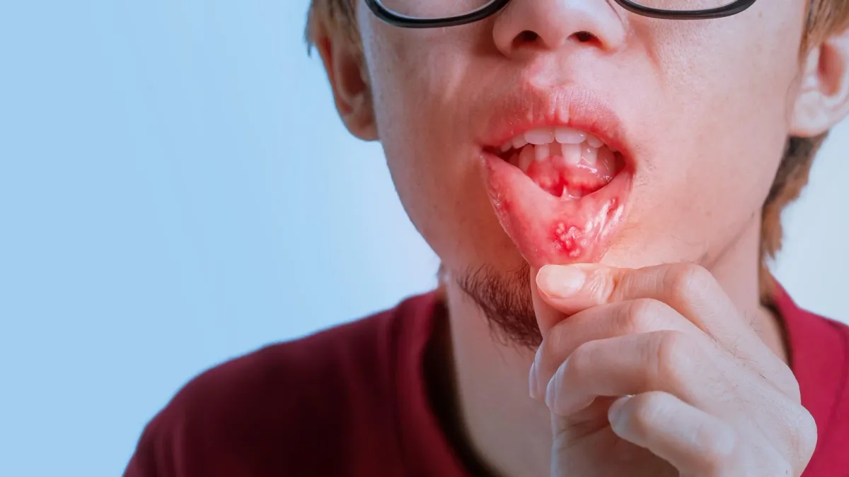 This image shows a mouth ulcer on the lining of the lower lip
