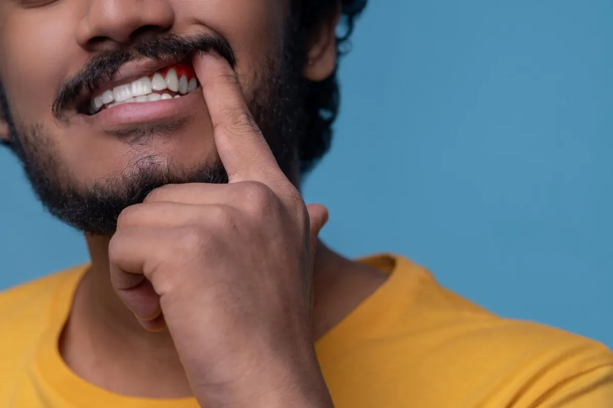 man examining a Bump on your Gums by pulling back his upper lip to check for swelling and changes in the gum tissue.