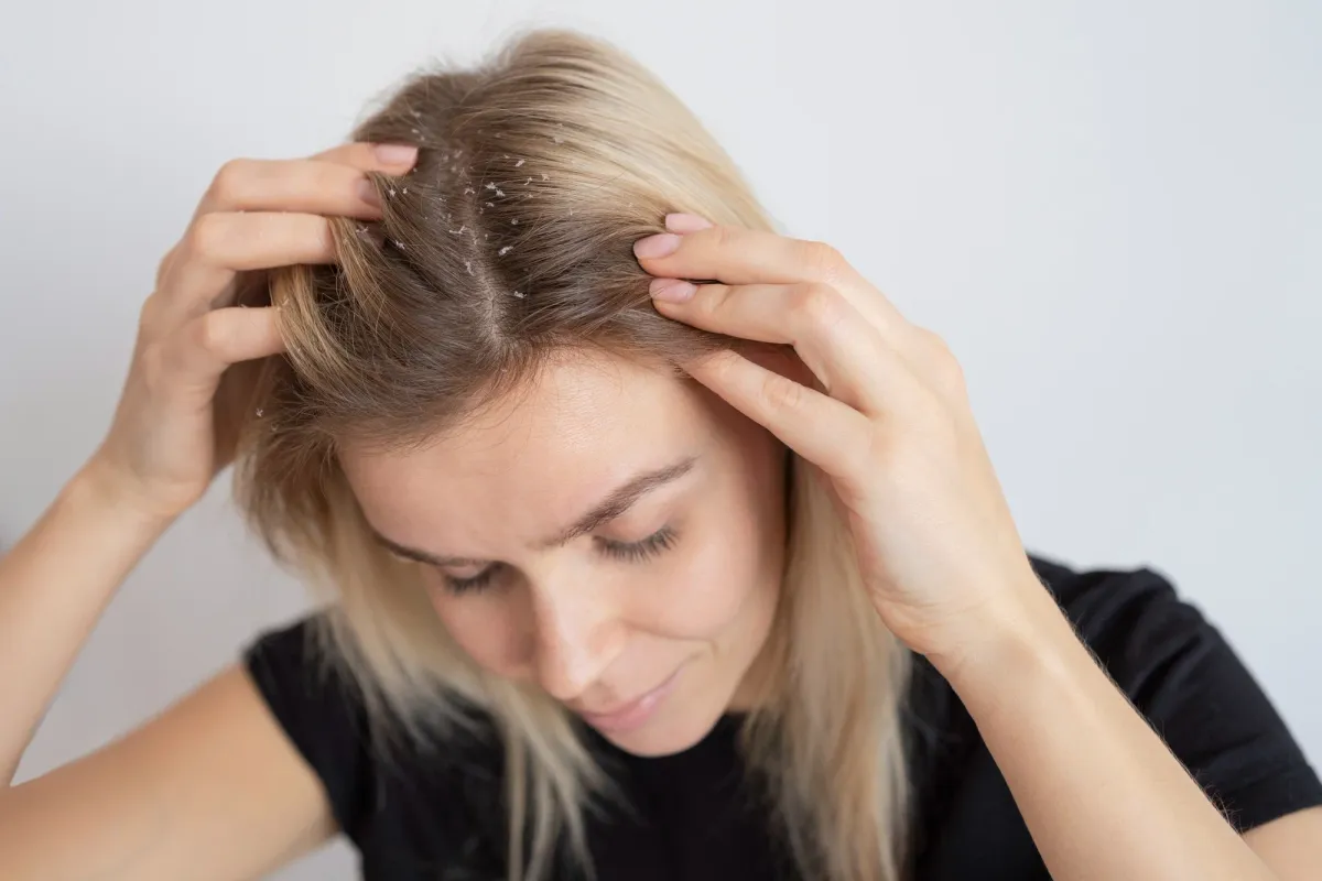 lose-up of a woman examining white flakes on her scalp while parting her hair, illustrating the difference between Dry Scalp vs Dandruff.