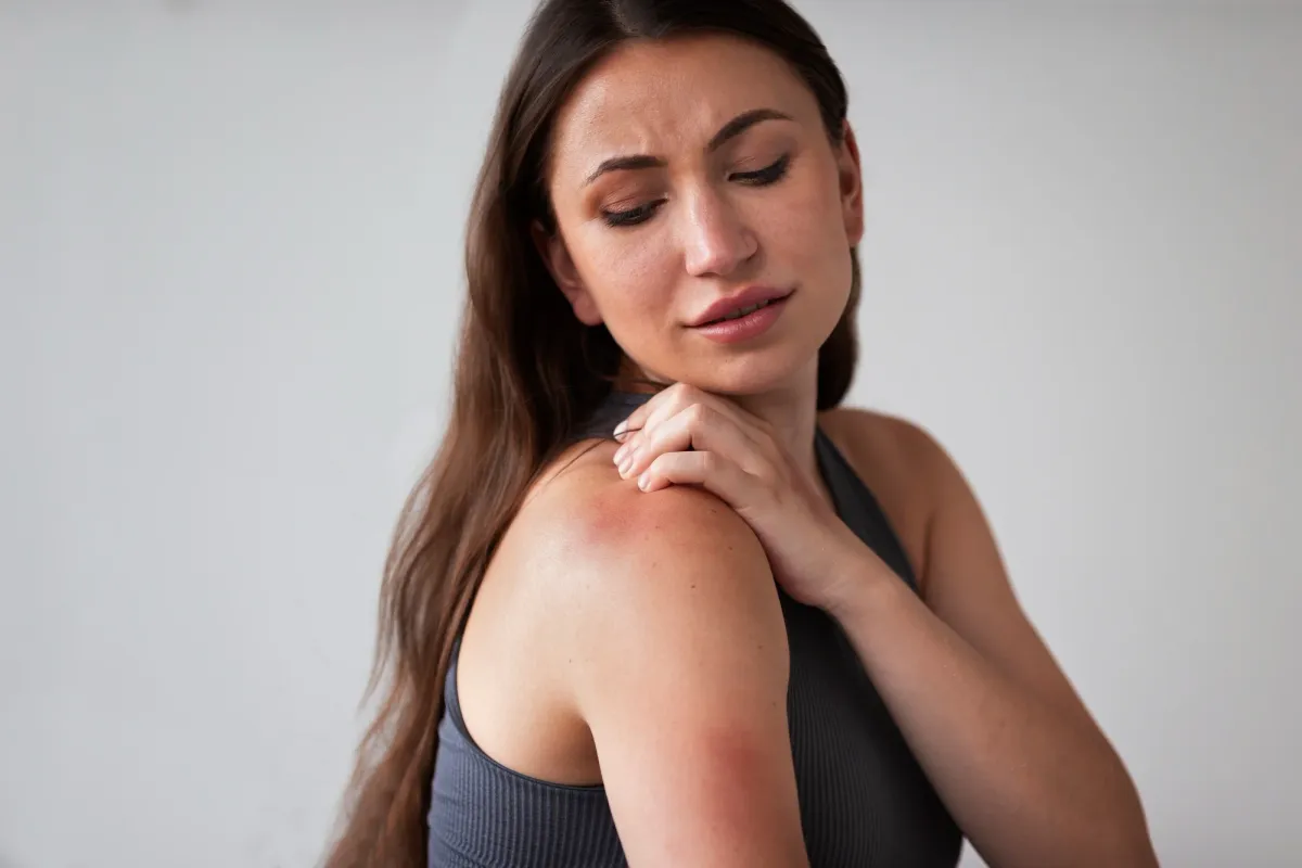 Close-up of a woman with a red, itchy rash on her shoulder and upper arm illustrating Is Eczema Contagious? and highlighting the appearance of inflamed eczema patches.